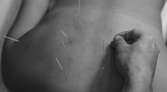 Dry Needling at Projection High Performance